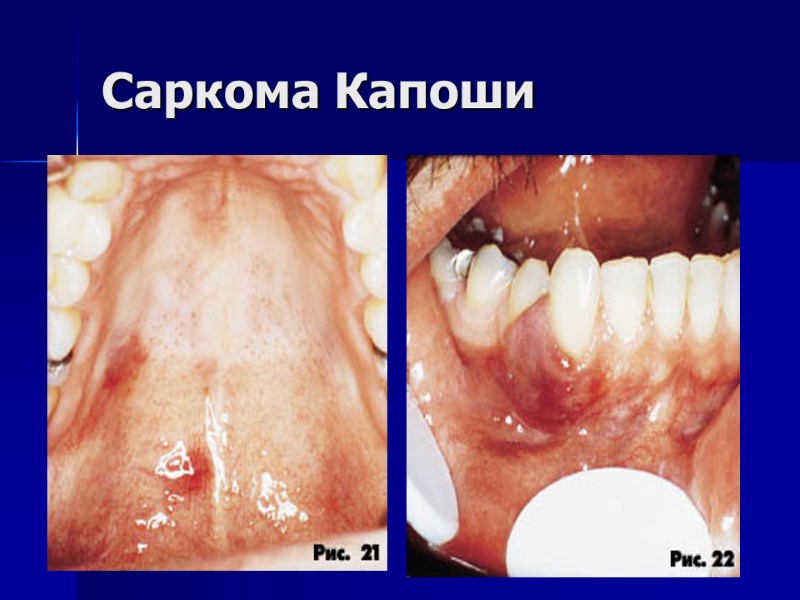 Саркома Капоши